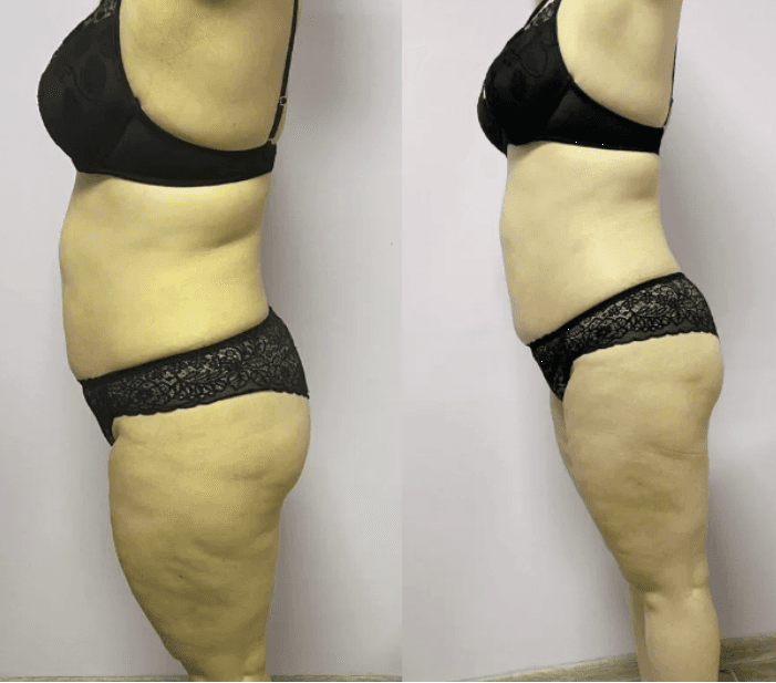 Аппаратный массаж/Коррекция фигуры - photo 2