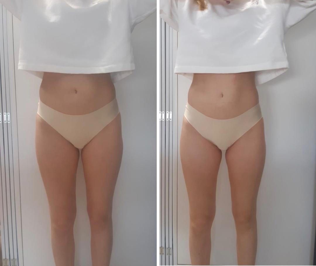 Аппаратный массаж/Коррекция фигуры - photo 3